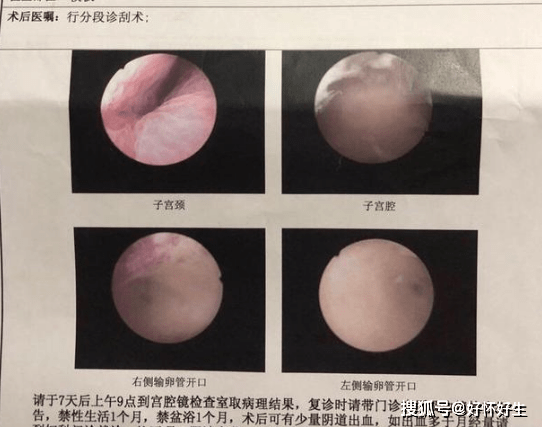 宫腔内囊性结构图片