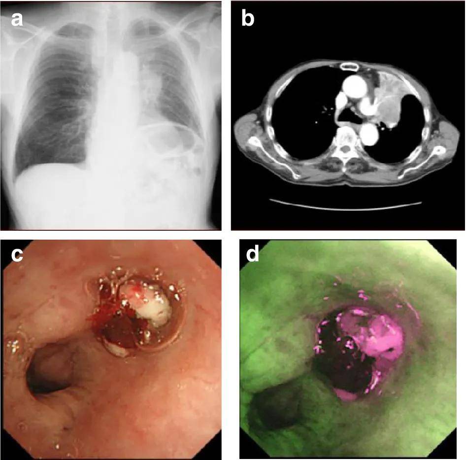 低分化肺鳞癌图片