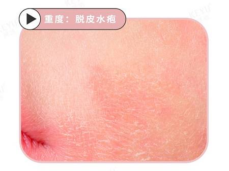 不同程度的晒伤如何表现,点击查看你属于哪一级晒伤_肌肤