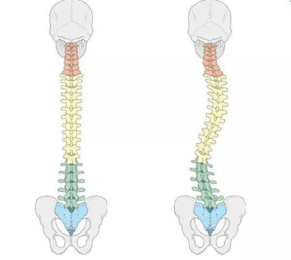 脊柱侧弯是一种脊柱的三维畸形,正常人的脊柱从后面看应该是一条直线