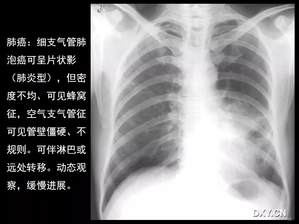 肺炎症結核腫瘤在ct及胸片上有哪些區別