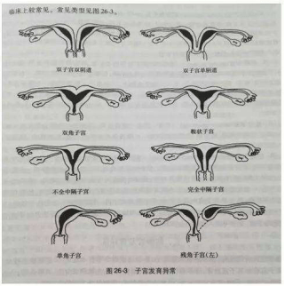 双阴道双子宫多囊卵巢不孕症患者成功孕育