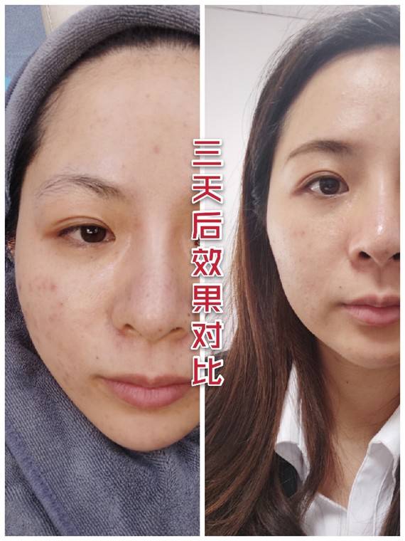 科普知识无针水光真的值得做吗