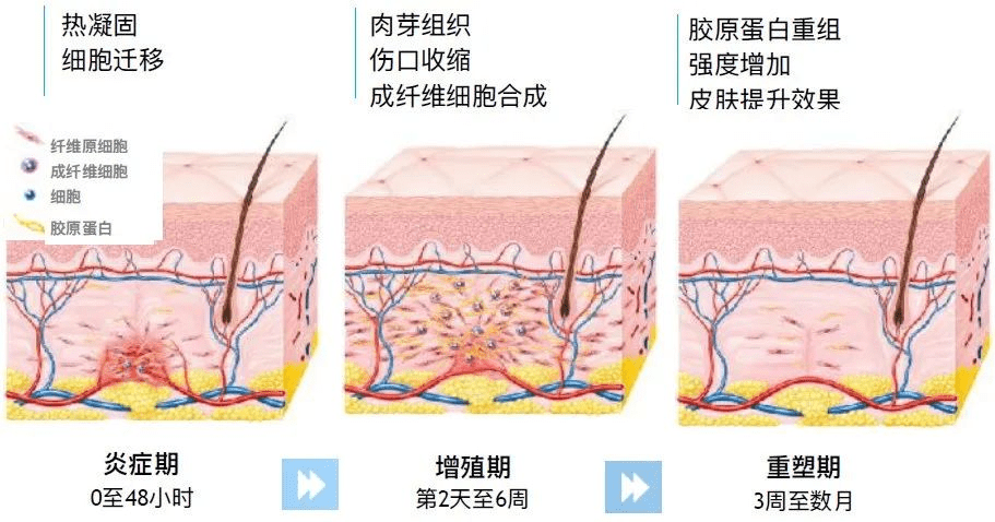 采美面部抗衰仪器推荐 Fotona4d 热玛吉 Ulthera超声刀 治疗