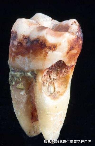 龈下结石不容小觑,它的危害和治疗方法你都知道吗?