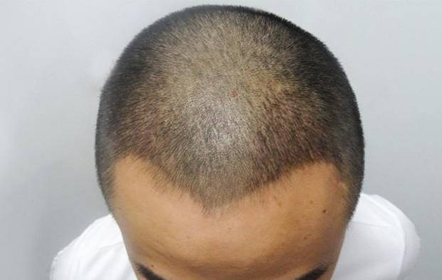 植发可以维持多久呢种头发原理是什么呢