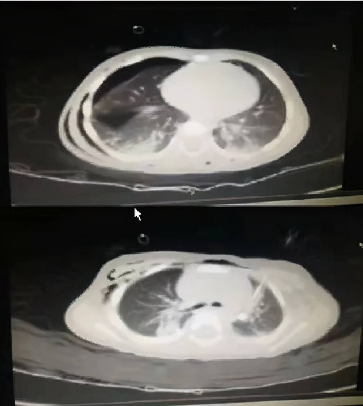 全麻下小儿腹腔镜疝手术并发双侧气胸1例_手机搜狐网