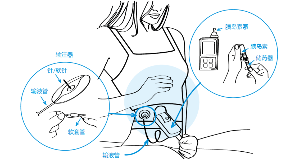 糖尿病史记:胰岛素"泵"