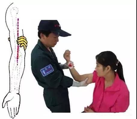 【急救科普】——止血法