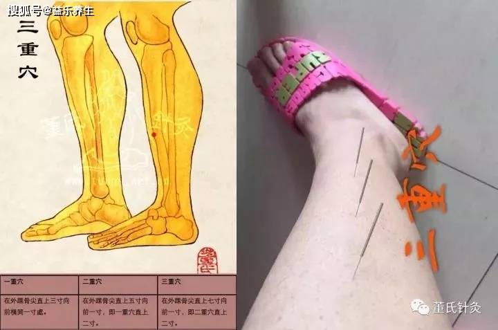 下肢偏瘫针灸部位图图片