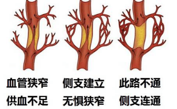 脑心健缺血预适应训练仪促进侧支循环建立脑心健缺血预适应训练仪,由