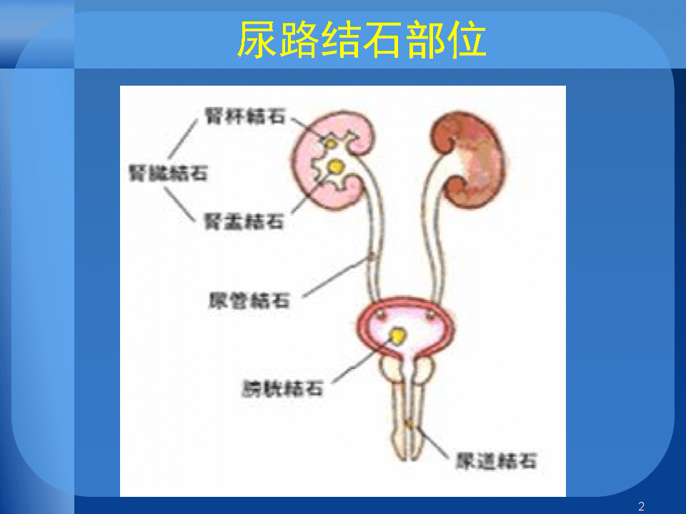 尿路结石位置图片