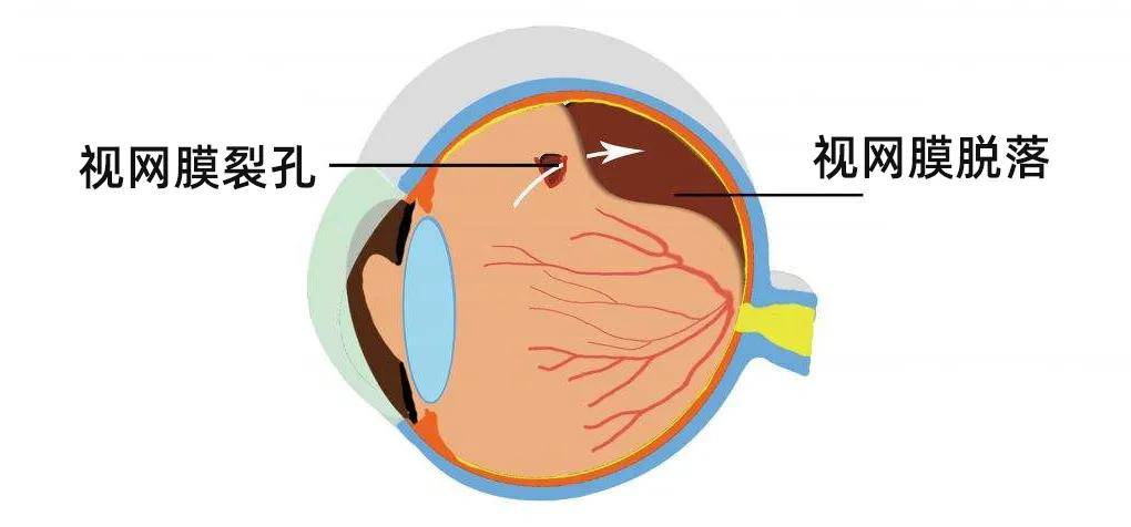 嗨視力眼視光丨視網膜脫落易導致失明,這幾種人尤其要注意!