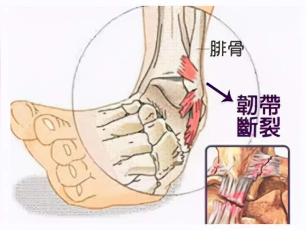 踝關節扭傷常見問題