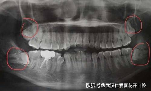 什麼樣的智齒需要拔?