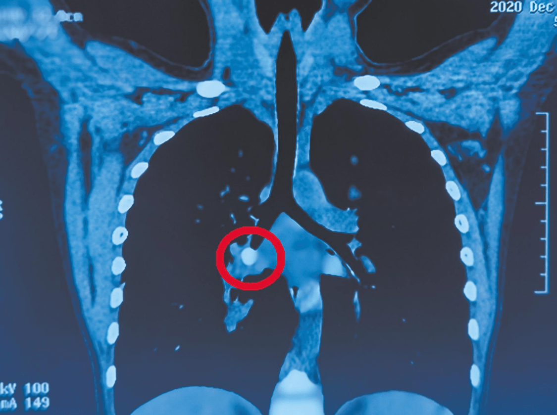 肺部ct显示,孩子的右下肺处有一高密度的异物影,将此处的支气管堵得严