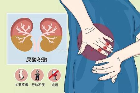 融晶保腎調代謝痛風患者為啥要保腎