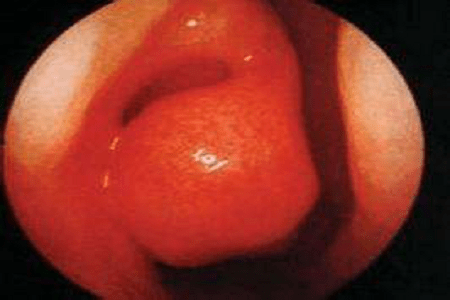 鼻粘膜充血肿胀图片图片