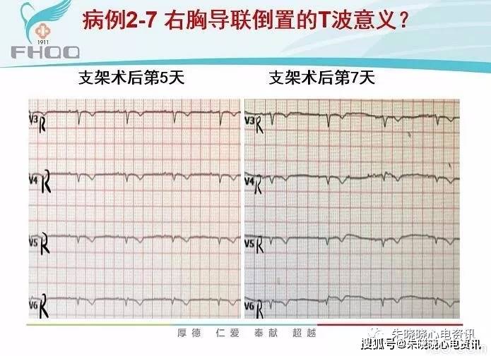 來源於醫脈通61v7-v9導聯st段抬高>0.5mm,證實後壁心梗.