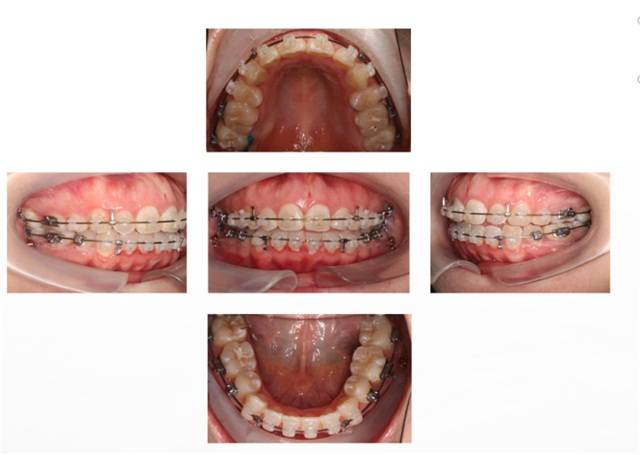正畸9张照片图片图片