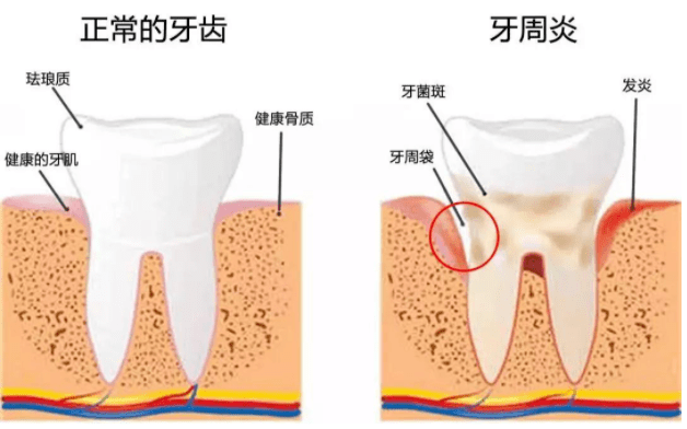 牙周袋自己如何看图片