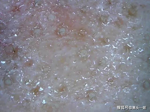 显微镜下的皮肤垃圾图片