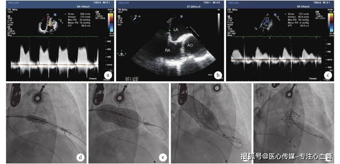 病例报告丨股静脉-房间隔途径经导管二尖瓣置换术一例_mm