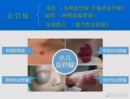 科普知识不同类型的血管瘤早期症状不同有的不易察觉