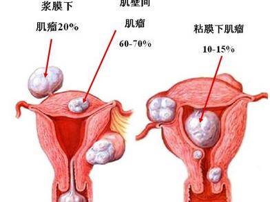 宫颈肿瘤 正常图片