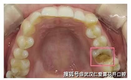 如果你的蛀牙到這種程度了就不能靠補牙拯救了