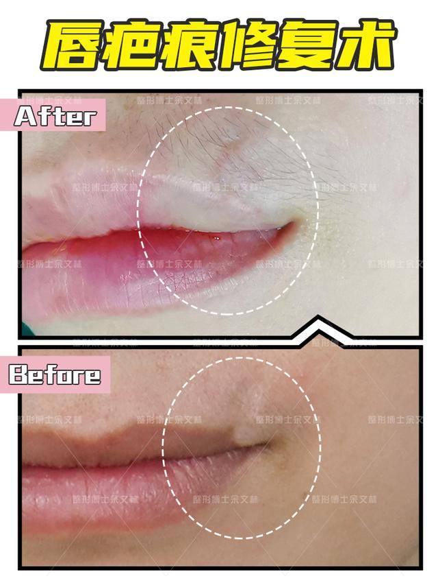 余文林博士既修复得了唇裂又修复得了瘢痕