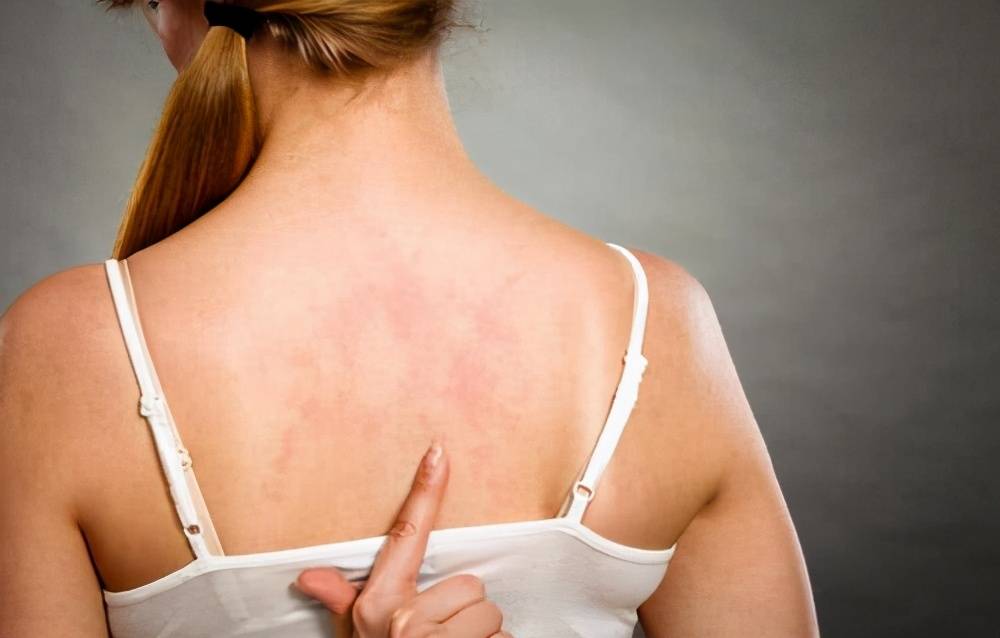 后背长了很多痘痘医生提醒先别挠多半是你没有做好这几件事