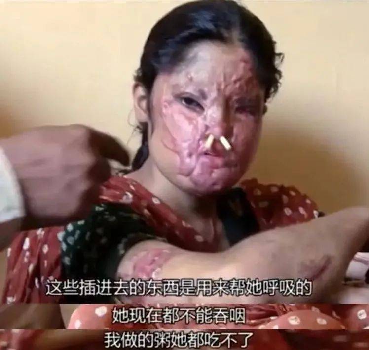 被泼硫酸,毁容失明,她们却登上伦敦秀场,获百万人点赞:我们将继续美丽