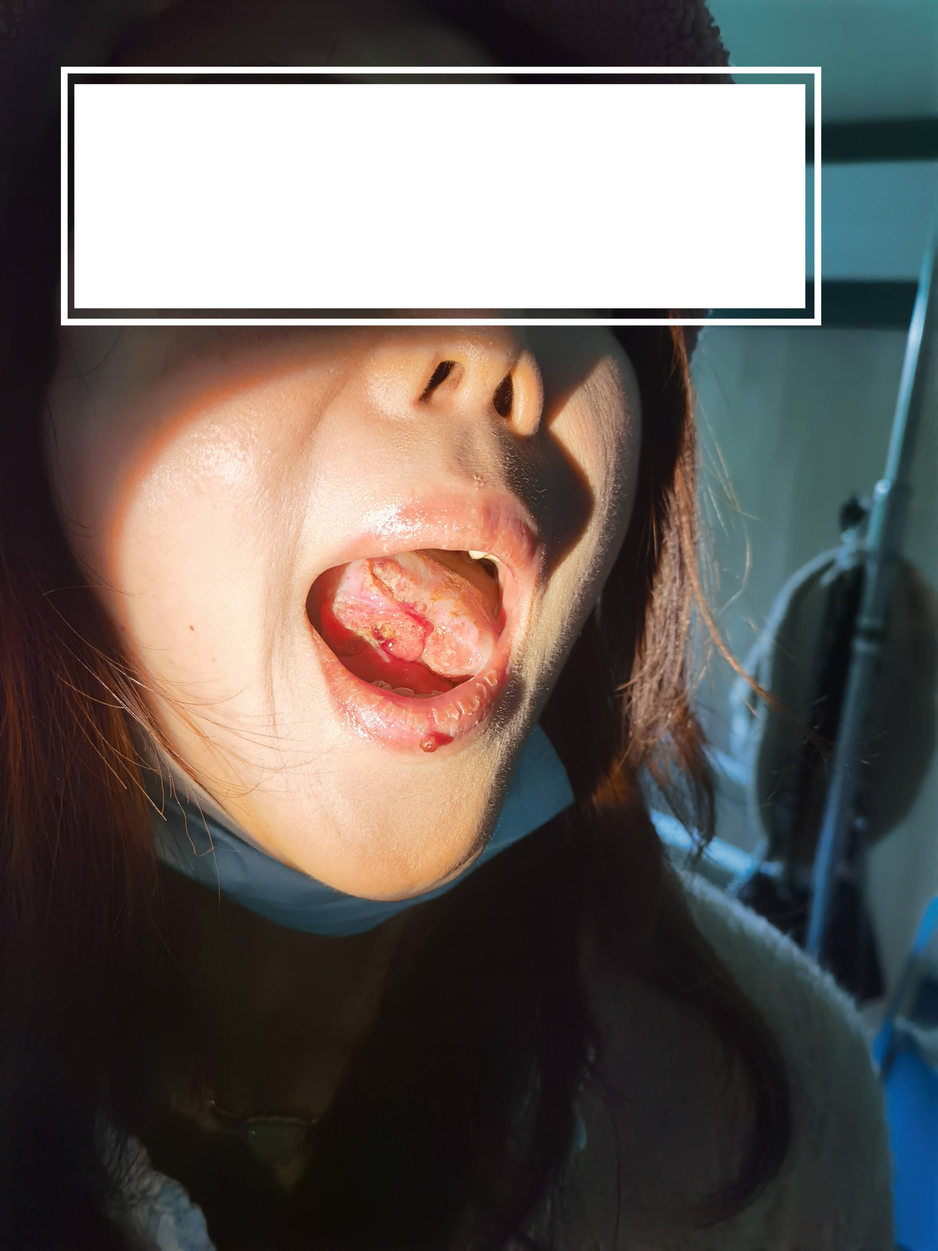 舌癌和上火的区别图片