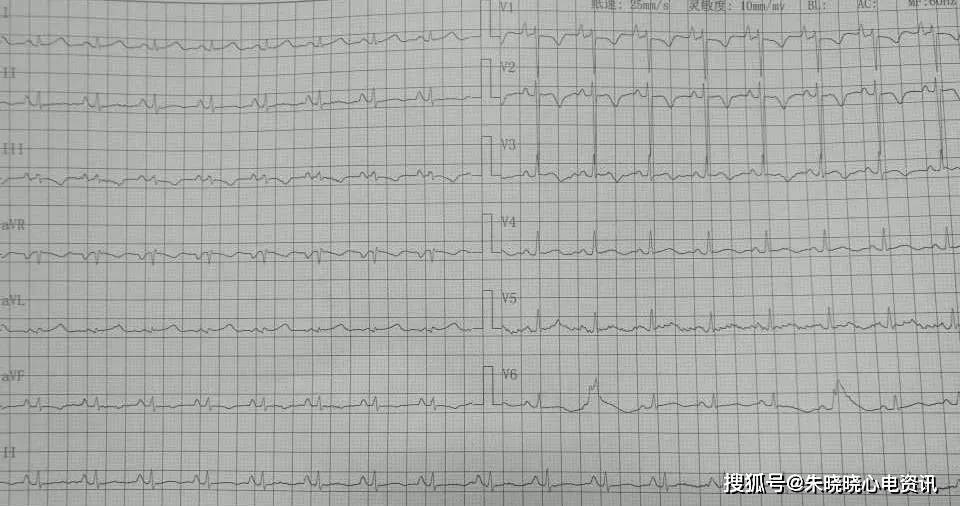 "低调而华丽"的p波_心电图
