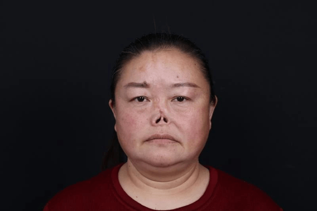 女子失鼻43年,陷入缺失人生的痛苦,直至遇到新氧公益