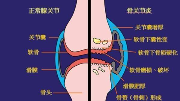 部分患者會出現手指遠端關節炎,但手掌,手腕等關節較少