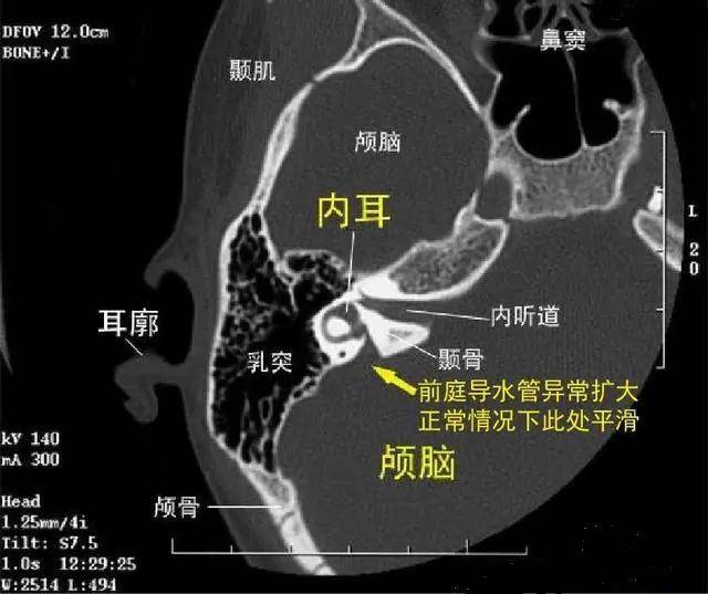 耳蜗导水管图片