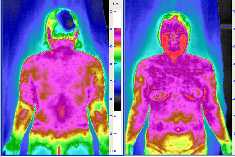 医用红外热像仪九种体质红外热图特征