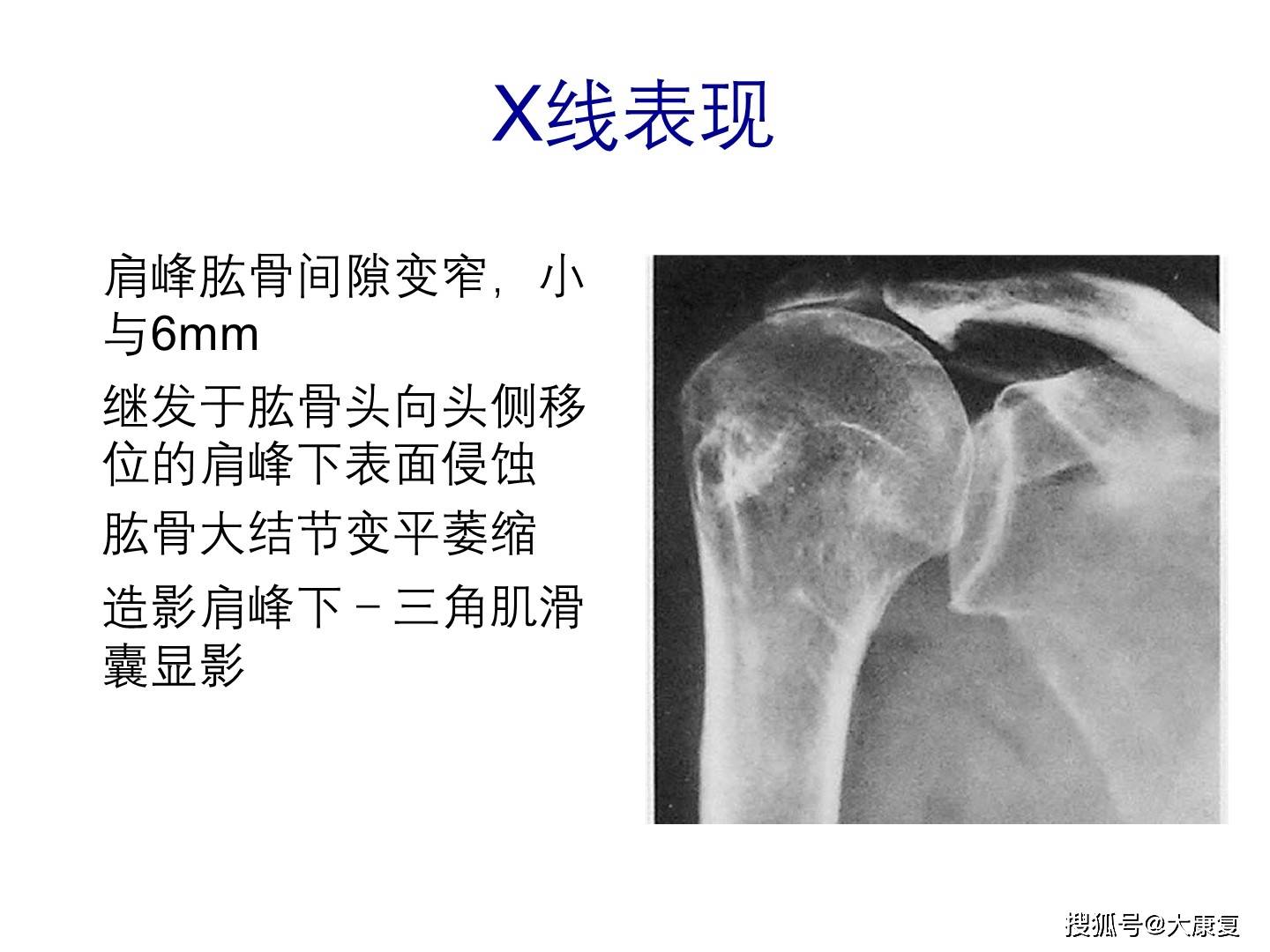 肩關節運動損傷影像診斷