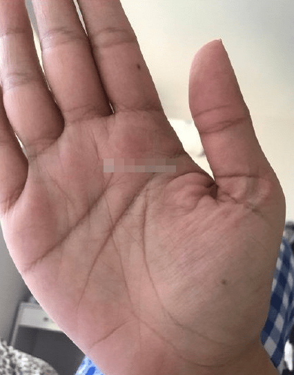 金星丘有痣,富裕之象,只要持之以恒,好日子等着你.