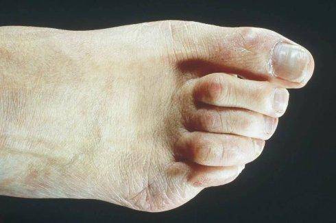 首先我们看两张锤状趾图片