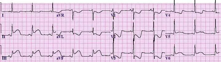 急性心梗的5類心電圖表現你遇到過嗎