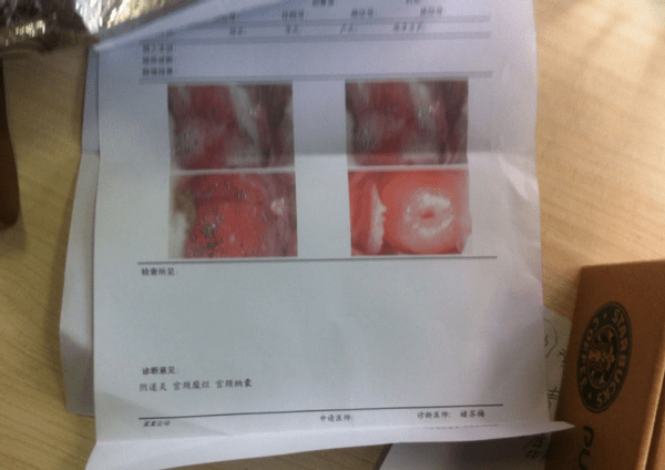 宫颈癌晚期 来自搜狐网