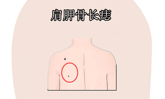 肩胛骨长痣在相学当中,在肩胛骨的位置处长有吉痣,被称之为巨富痣