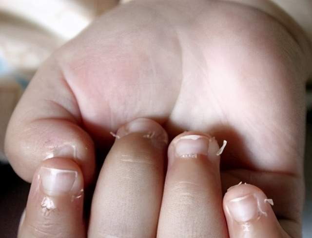 孩子手上出现倒刺难道是孩子缺钙的表现这些原因需要家长知道