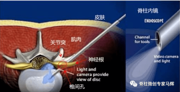 名医专访 | 上海九院马辉:椎间孔镜手术常见问题
