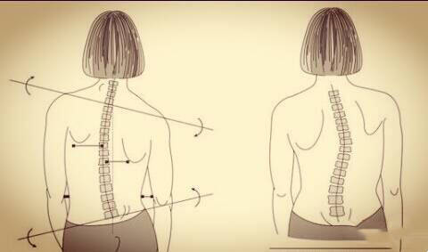 高低肩看孩子胸廓是否偏向一侧,肩胛骨和腰部是否左右对称,下肢是否
