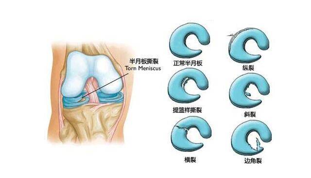 半月板三级损伤怎么办