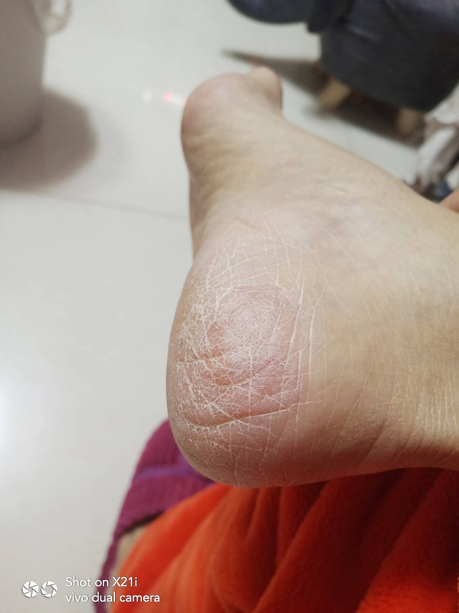 脚裂做这3件事女人自己心里要有数